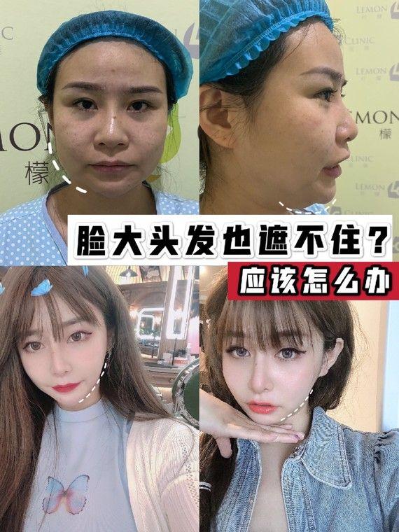 【案例分享】面部吸脂,对大脸说"拜拜"