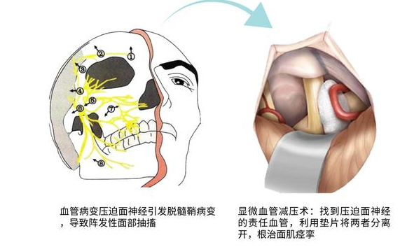 面部神经抽搐怎么办