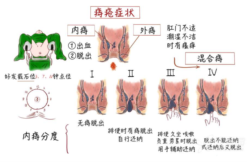 痔疮的症状有哪些