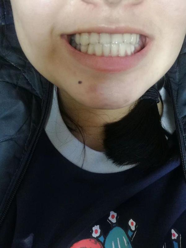 轻微骨性地包天正畸矫正流水账