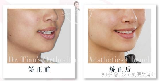 内倾型深覆合牙齿重度拥挤下颌后缩矫正后牙齿排列良好咬合关系为完全