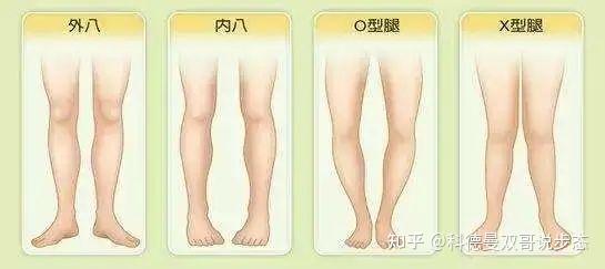 由于孩子腿部和踝关节的力量不足或者扁平足等问题,导致足内旋,足外旋