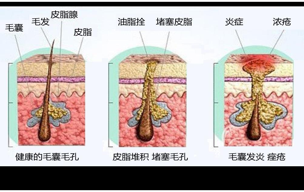 痘痘肌肤的调理方向什么是安全有效的?