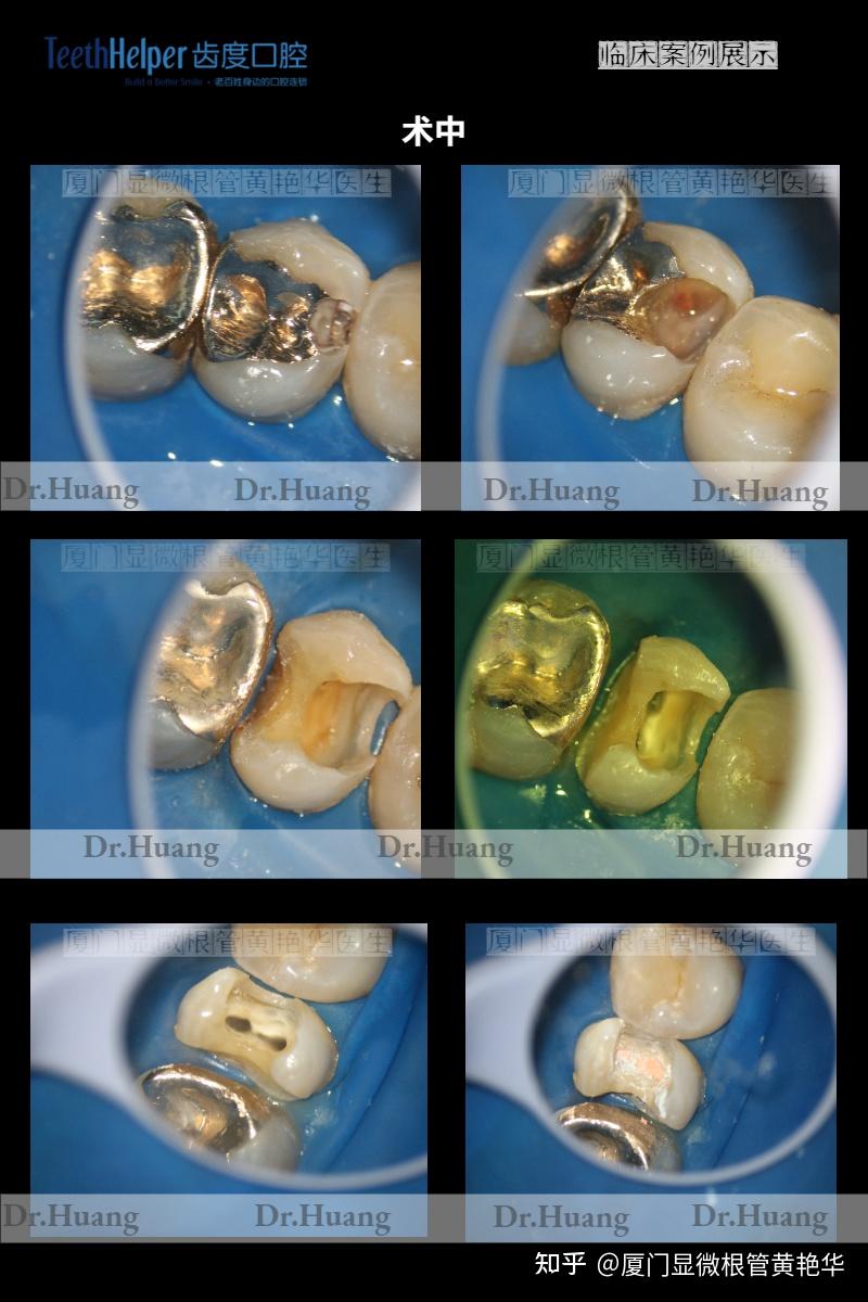 你看得出这是一颗修复过的牙齿吗全瓷嵌体二次修复一例