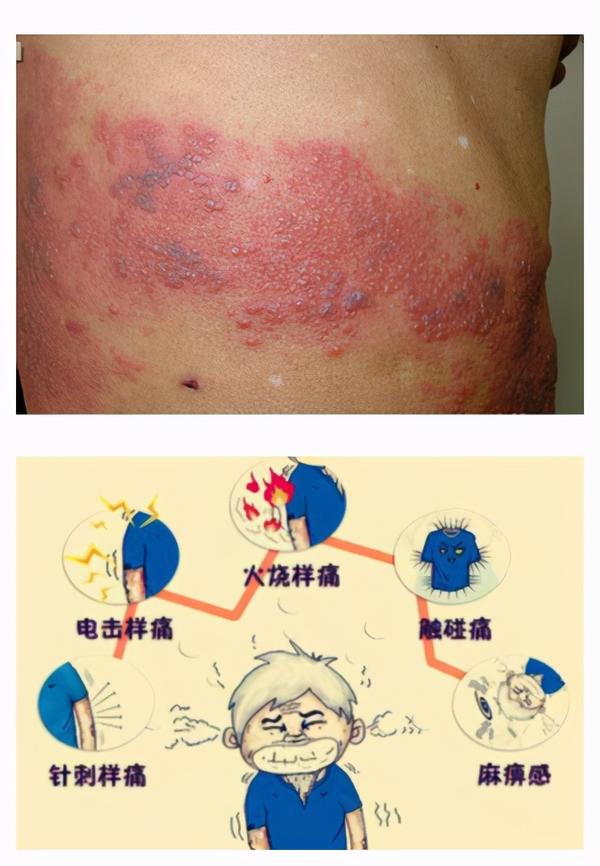 持续1~3天,身体一侧出现红斑,其上见簇集性丘疹,丘疱疹,水疱