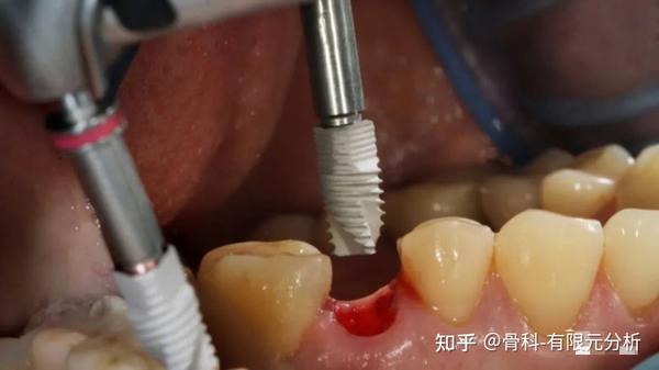 学习| 种植牙修复过程中常出现的并发症及其处理