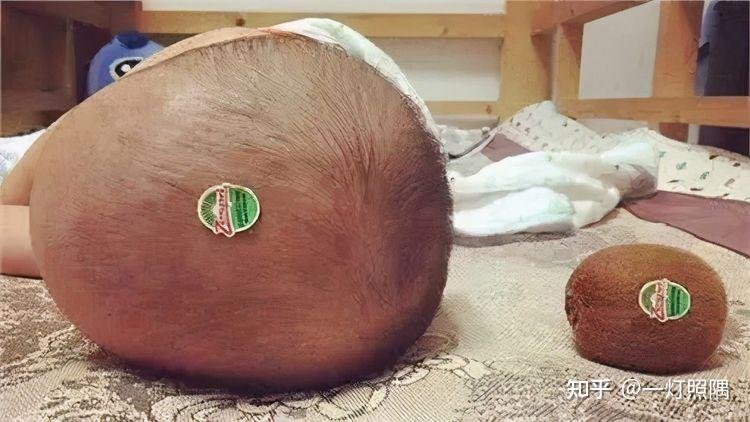 为什么新生儿有的头发多有的头发少如何帮孩子告别小秃头
