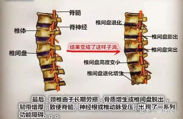 低头时,突然引发全身麻木或有"过电"样感觉者(大多为脊髓型颈椎病