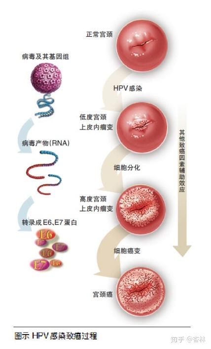 hpv分型及致癌性 根据病毒致癌性大小分为两型 低危型hpv(非癌相关