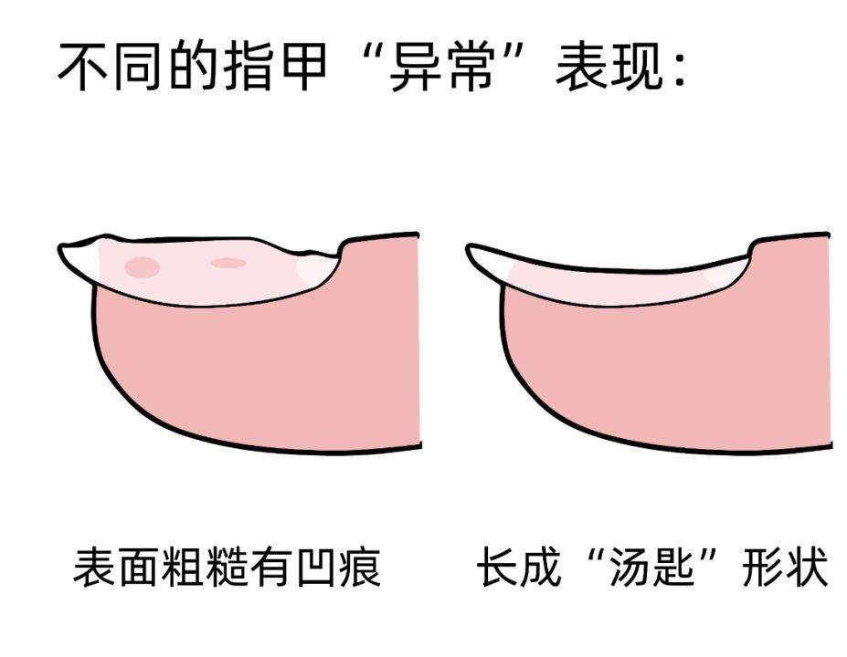 指甲表面粗糙有凹痕指甲出现凹洞或凹痕,医学上称为指甲顶针样改变