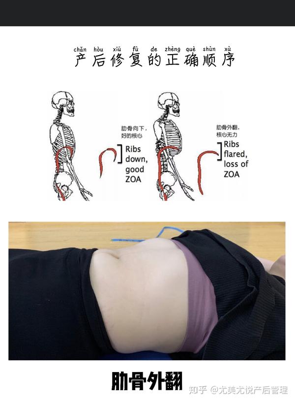 重点总结: 上面三个问题是最常见的也是最需要修复的 肋骨外翻和