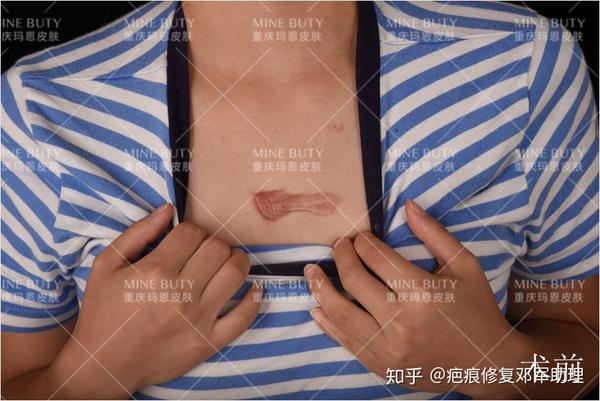 陈女士,28岁,胸部斑块11年 查:胸前部横向条状斑块 诊断:瘢痕疙瘩