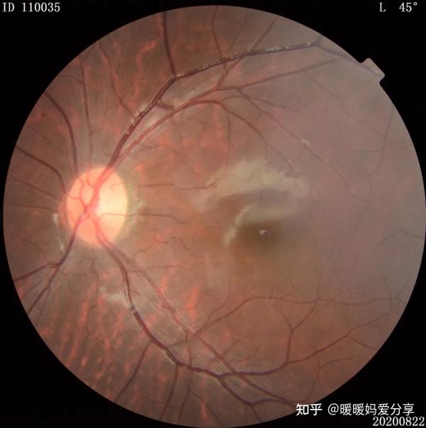 豹纹状眼底就是高度近视的典型眼底
