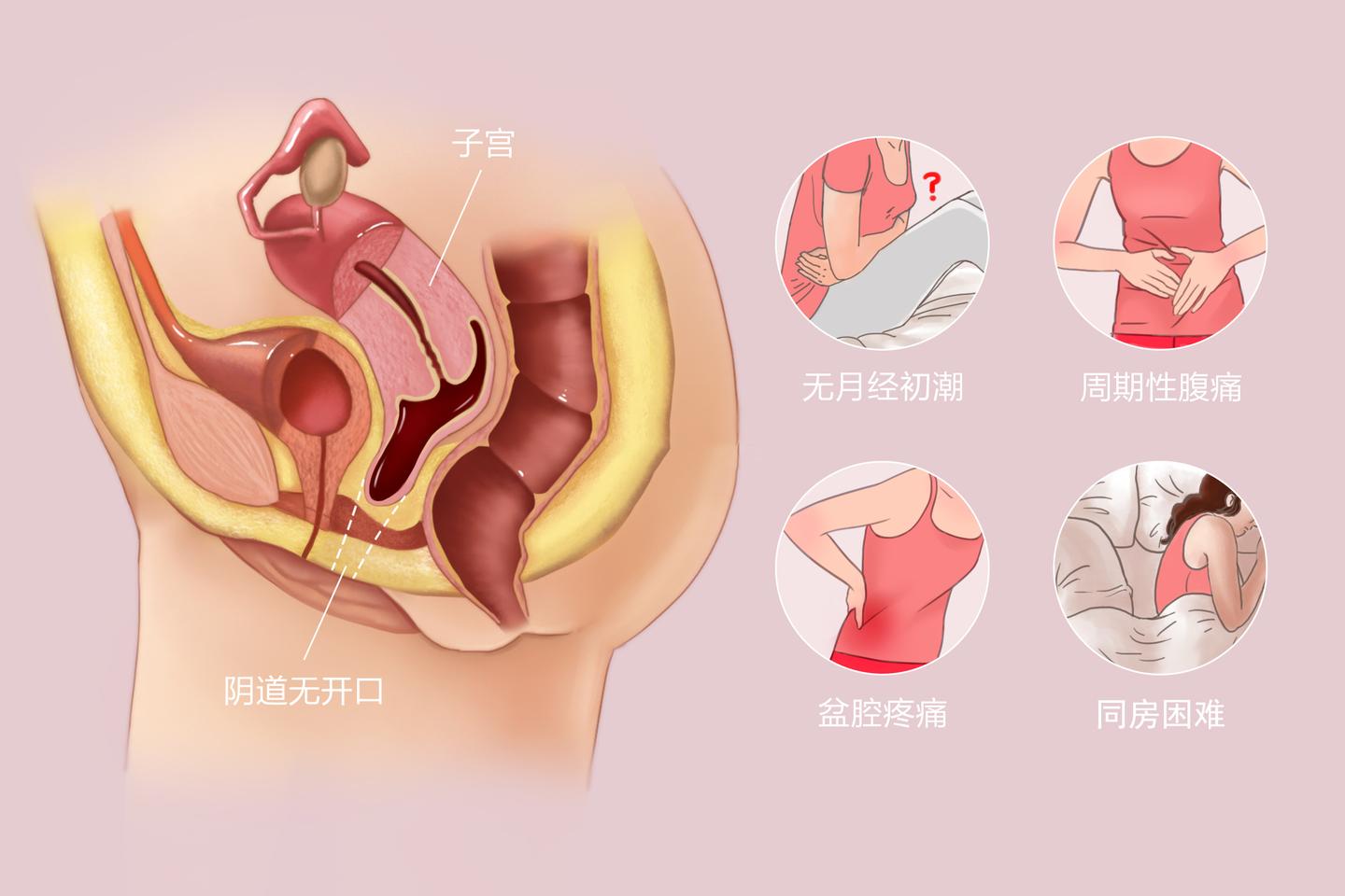 16岁高中女孩阴道闭锁 幼稚子宫?医生解答,并告诉你应该怎么办