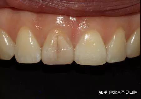 隐裂牙齿的表面会有一些细微不易被发现的裂纹,就像一个茶杯或碗碰坏