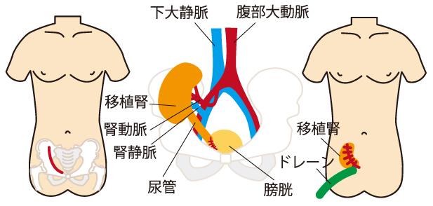 日本活体肾移植现状及数据