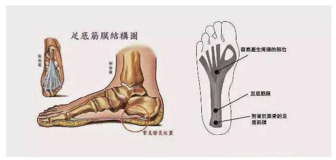 足底筋膜炎位置图