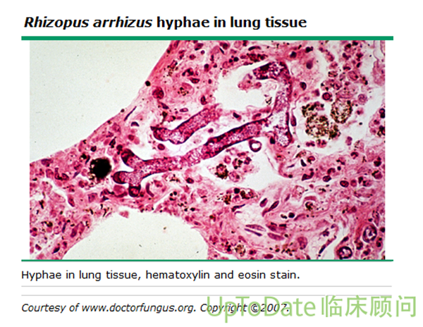 rhizopus arrhizus hyphae in lung tissue