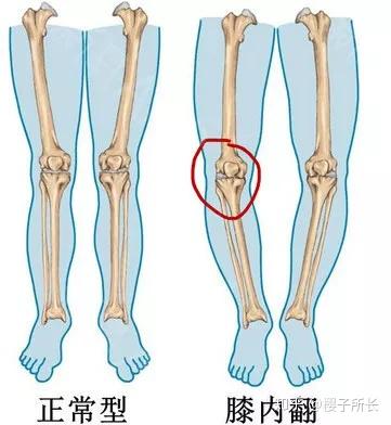 跟前面x型腿的膝外翻是一个道理,都属于膝关节的上下关节接触面不正