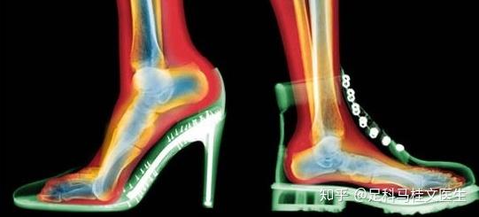 同样是穿高跟鞋为什么偏偏你得了大脚骨