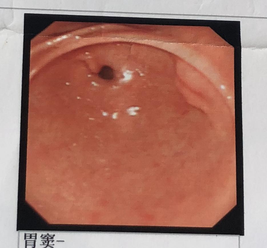 异位胰腺普通胃镜看到的是什么样子的