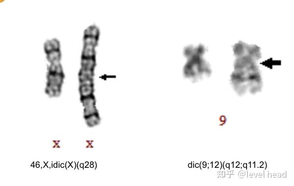 染色体,断裂和重接位于 13q14 和 13q32,从而组成一条双着丝粒染色体