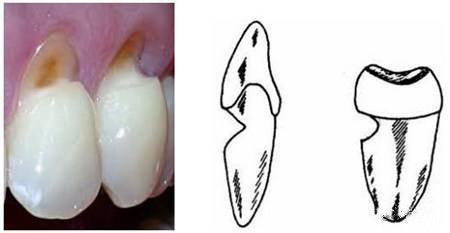 滴水可穿石刷牙方式错误可致牙齿楔状缺损