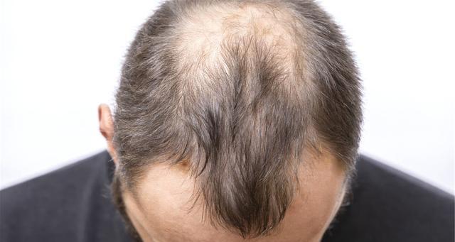 怎么治男性脂溢性脱发男人脂溢性脱发能治疗好吗
