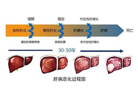 哪些病因是肝硬化的罪魁祸首