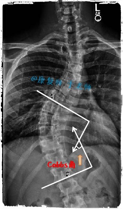 科布氏角度(cobb"s angle)的测量 科布氏角是用来定义脊柱侧弯在冠状