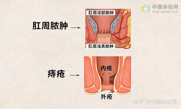 痔疮,肛周脓肿?会转变成结直肠癌吗?这三类人群需特别