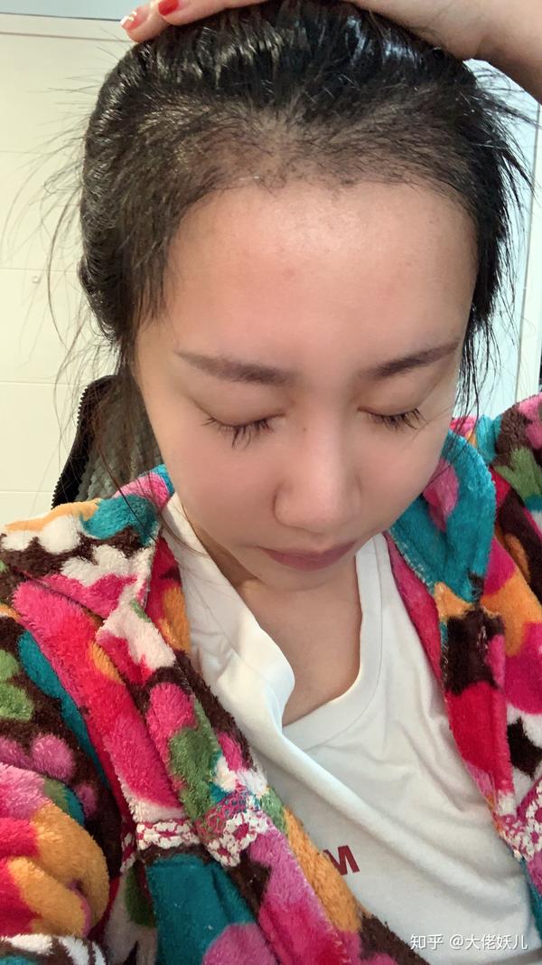 关于女生植发那些事儿!11月4日,我去植了发际线.
