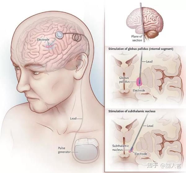 spiegel就和他的同事一起通过损毁苍白球 (globus pallidus) 来改善