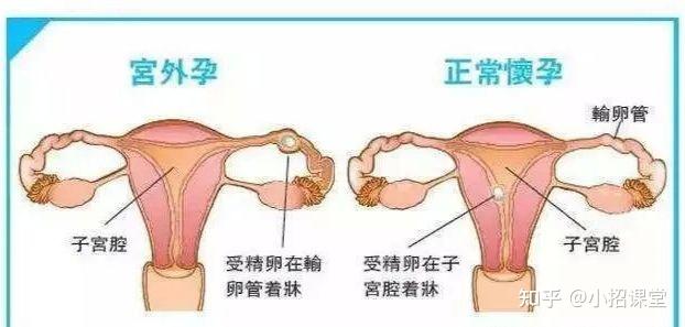 什么原因会导致宫外孕