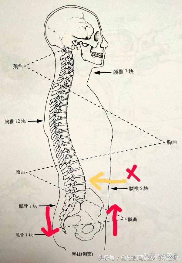 案例分析不是所有的腰椎问题都叫骨盆前倾