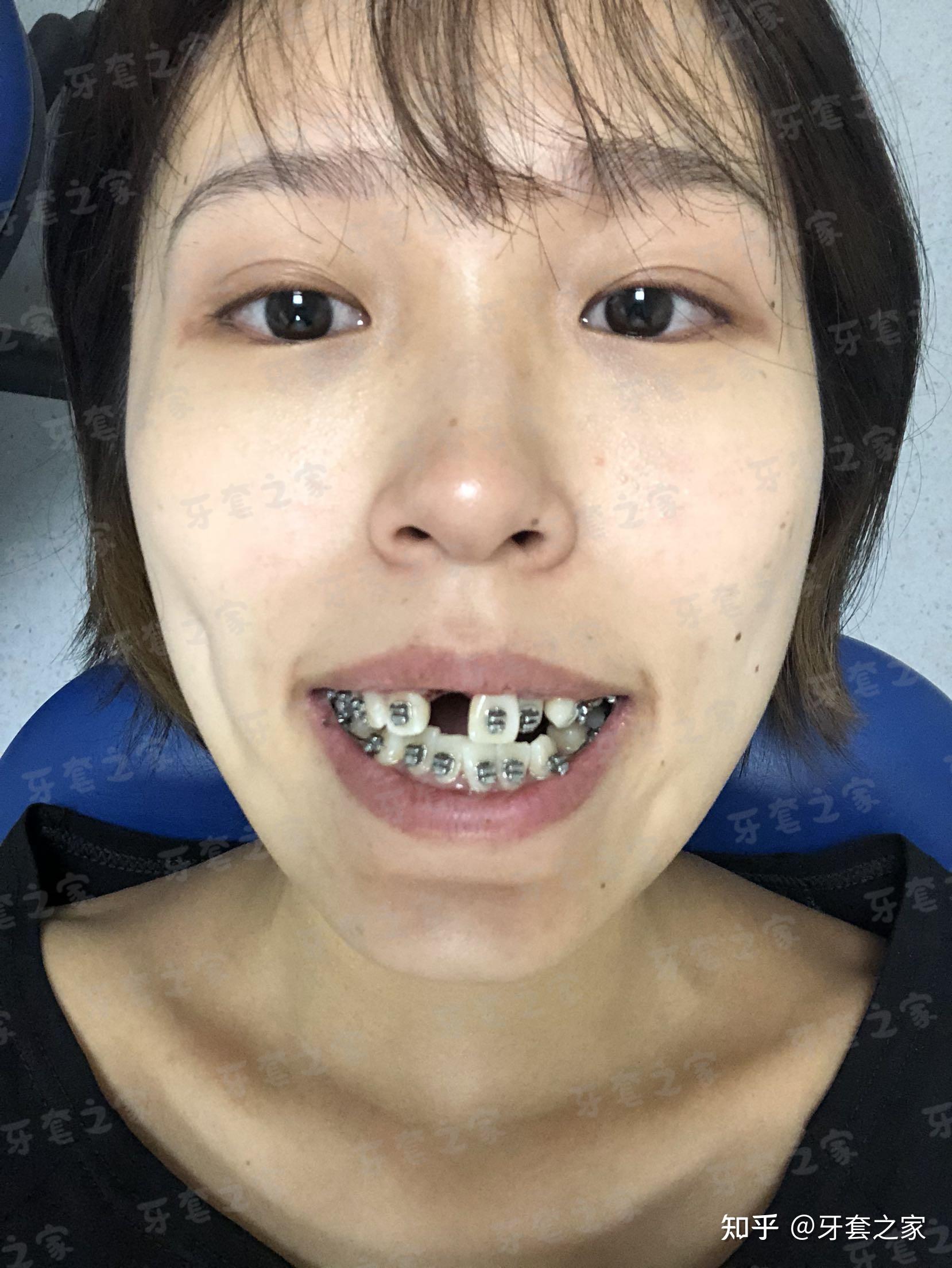 牙套记录牙齿乱凸嘴拔门牙矫正矫正两年多最难熬的是复诊最开心的也是