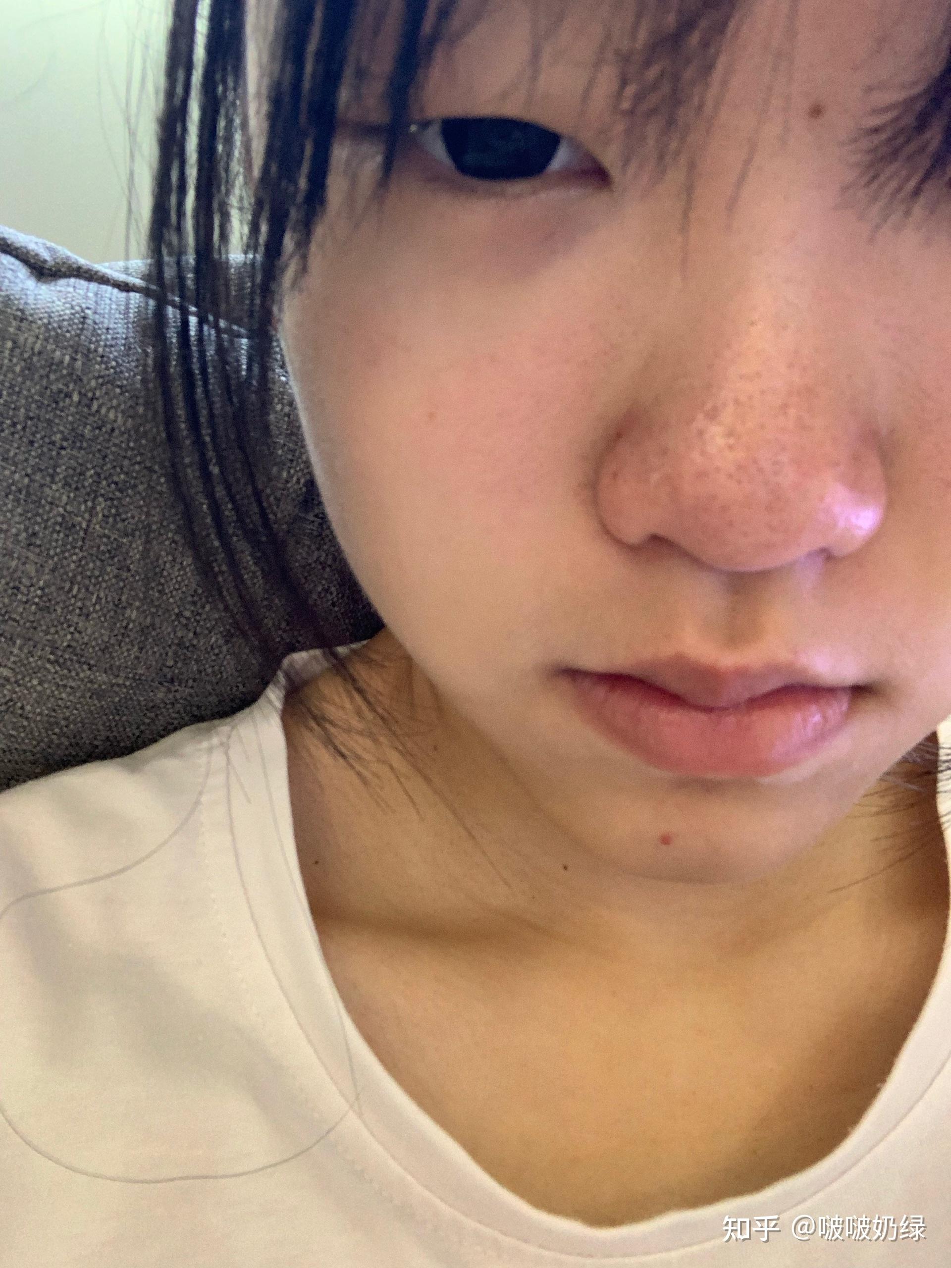 被亲戚骗去她的美容院挤黑头怎么办