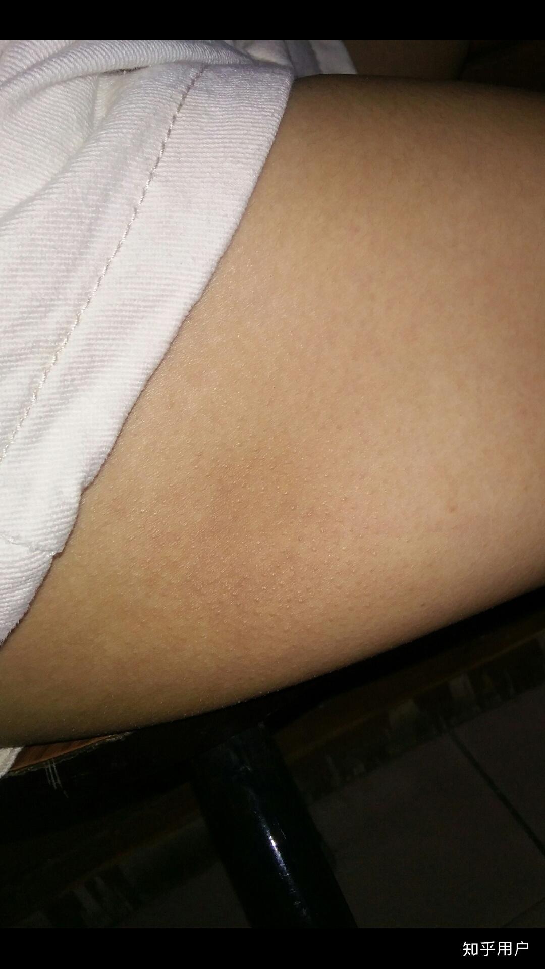 屁股与大腿交界处的皮肤一个一个点,看上去有点鸡皮肤,请问是什么情况