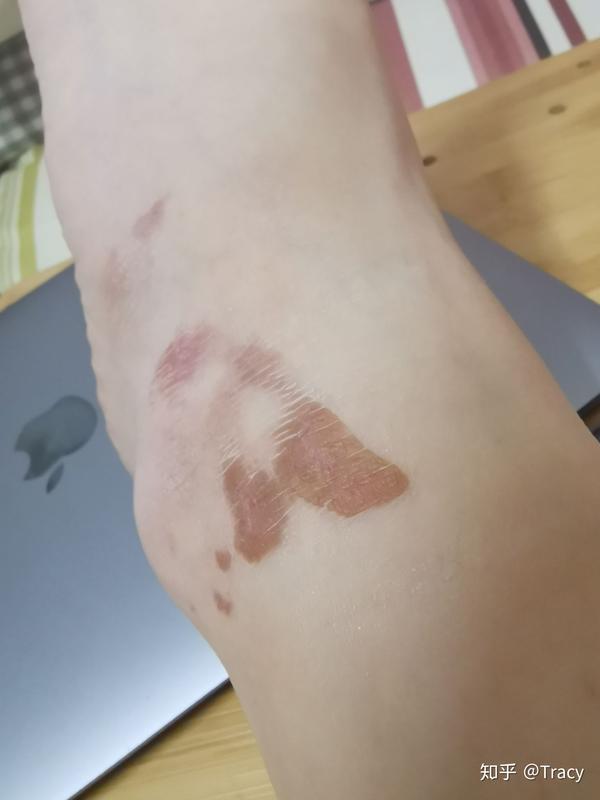 开水烫伤起水泡后每天的变化 (多图)