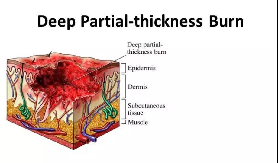 【百分之百正确的小技巧】快速分辨烧伤分度,妙算烧伤面积