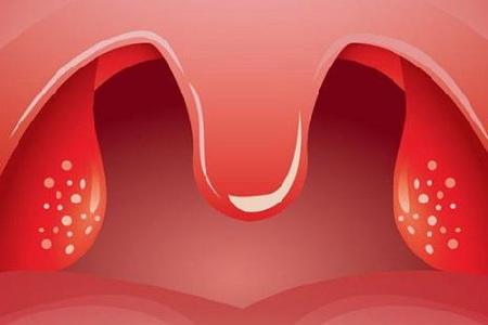 首大石萍:如何判断扁桃体发炎 怎么去预防护理