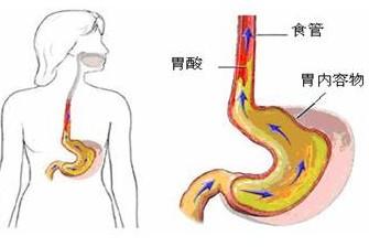 一文搞懂:胃食管反流病的诊断与治疗