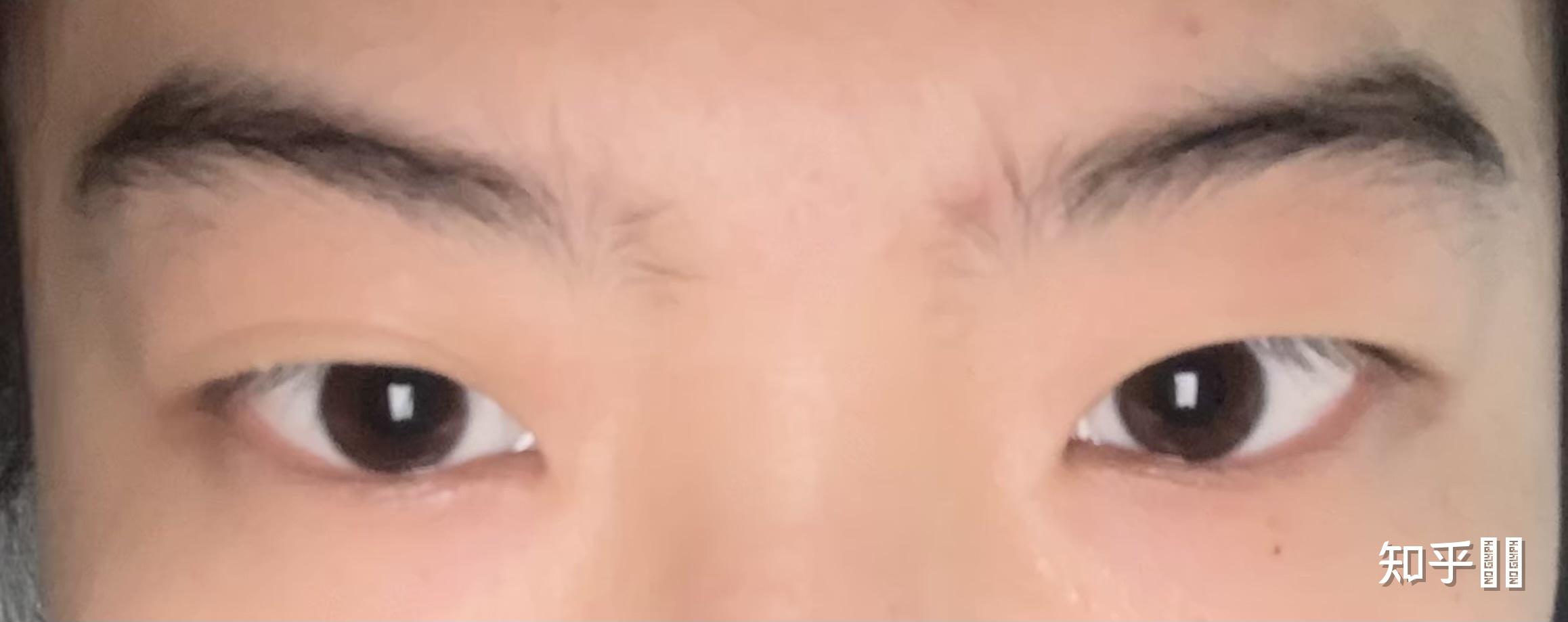 吊眼怎么整我的眼还有救吗
