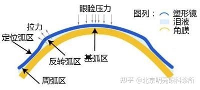 mct角膜塑形镜-青少年视力解决方案