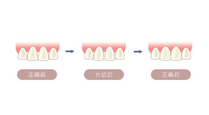 闫燕医生:正畸时什么情况下会用到片切?