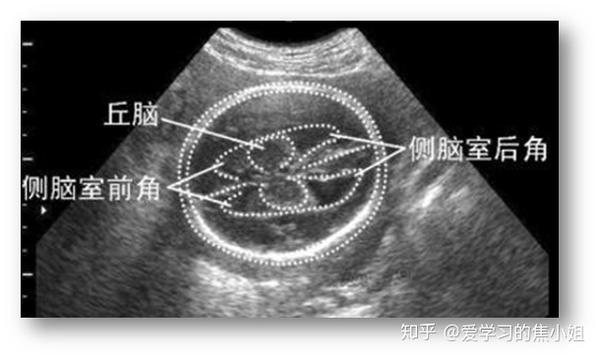脉络丛囊肿:是胎儿发育中的侧脑室的脉络丛中发现的超声离散的小囊肿