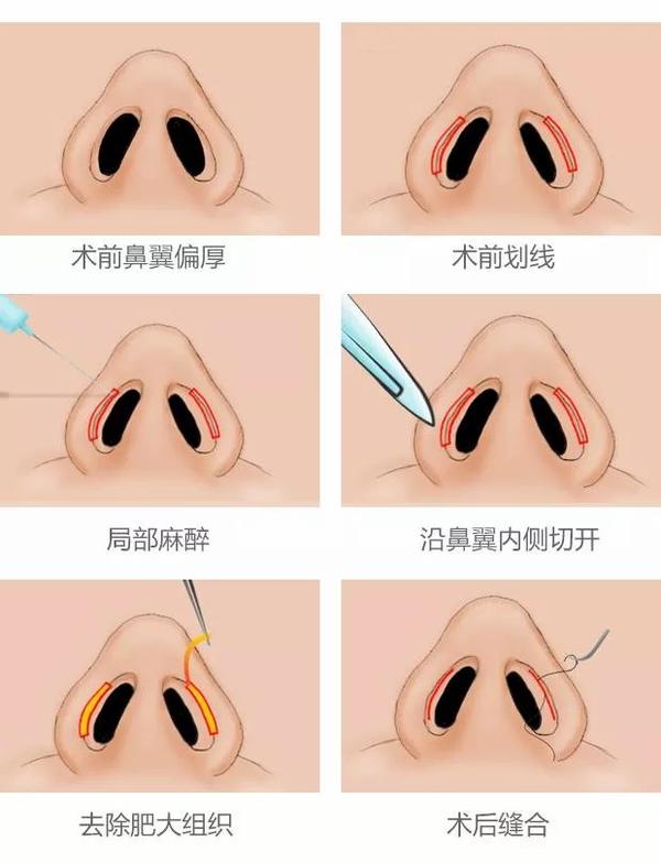 这时可以做内切,也就是在鼻孔内切除一块组织,缩小鼻孔减少鼻翼外扩