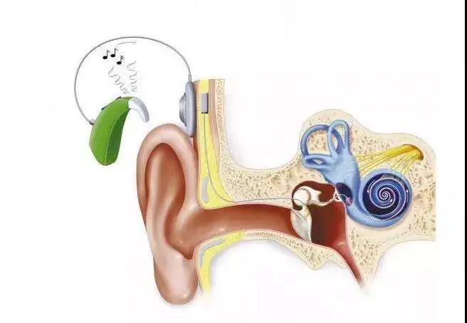 人工耳蜗基本知识二十一问一