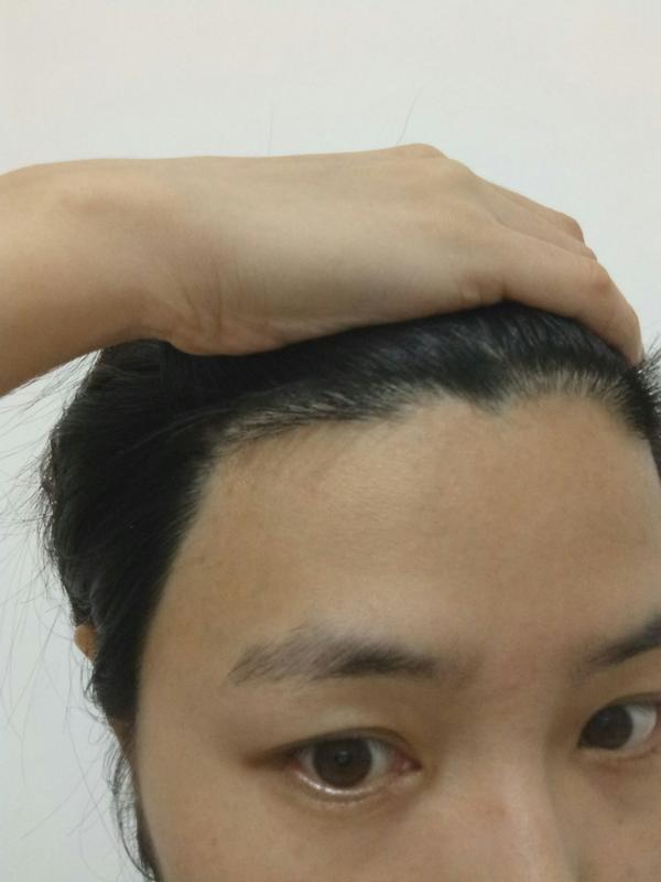 有没有因为额头低而脱发际线的?