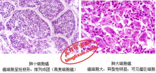 非小细胞型肺癌,包括肺鳞癌,肺腺癌和大细胞肺癌,与小细胞肺癌相比